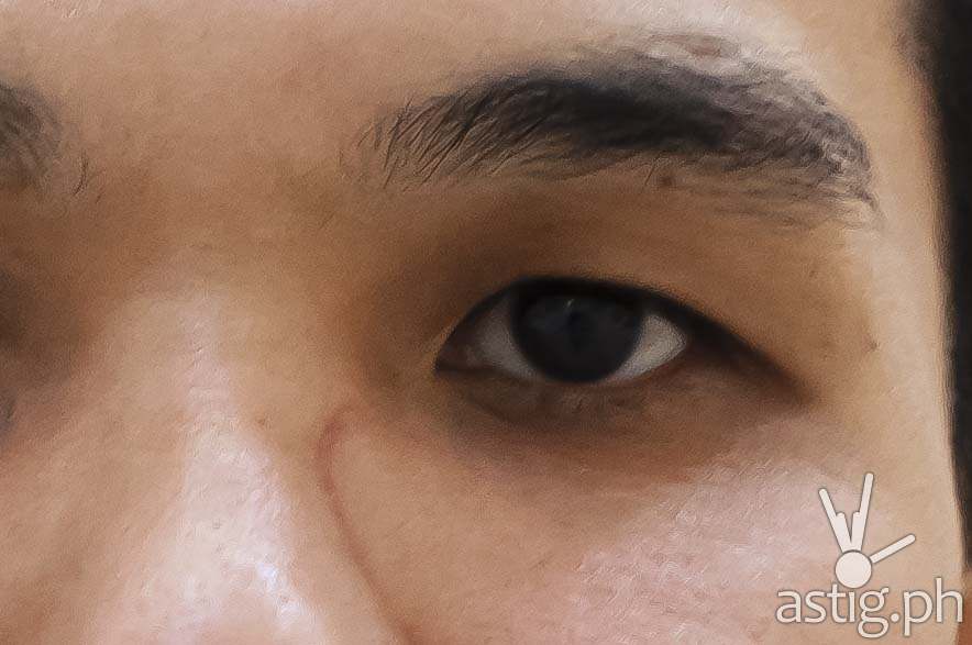 A heavy square showerhead fell on my face, resulting in this nasty scar on Valentine's Day