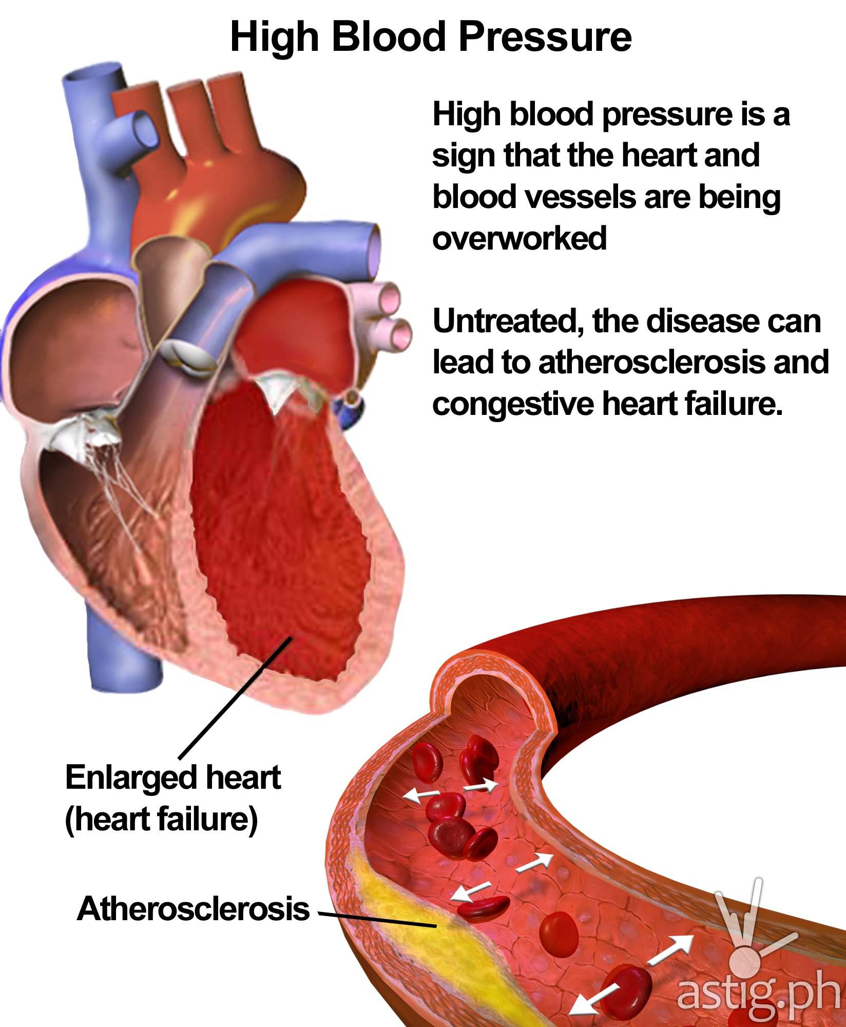 hypertension